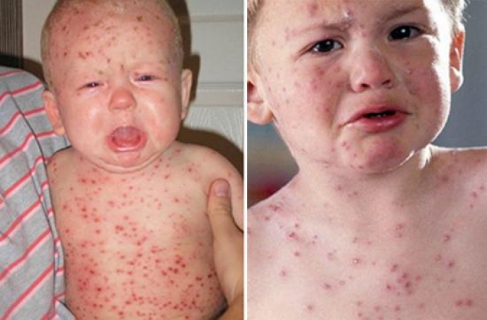 На Закарпатті зафіксовано вже 116 випадків захворювання на кір