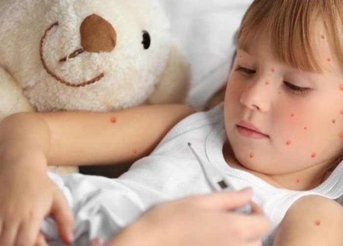 Сімнадцять захворювань на кір діагностовано у столиці Закарпаття