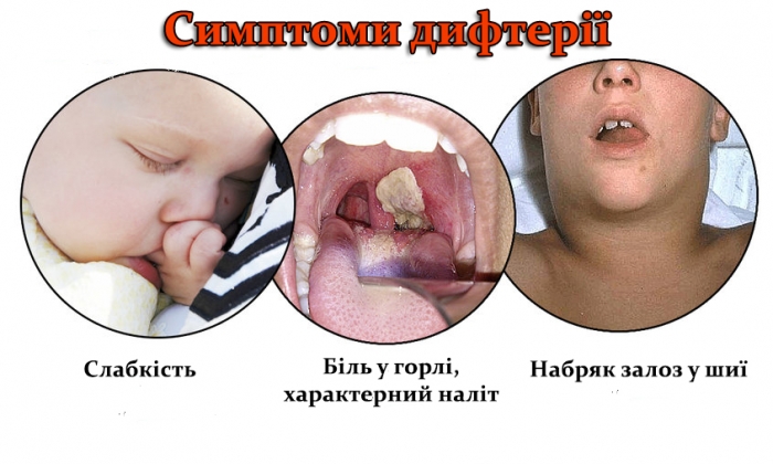 Останні випадки захворювання на дифтерію в Закарпатті фіксувались ще у 90-тих...