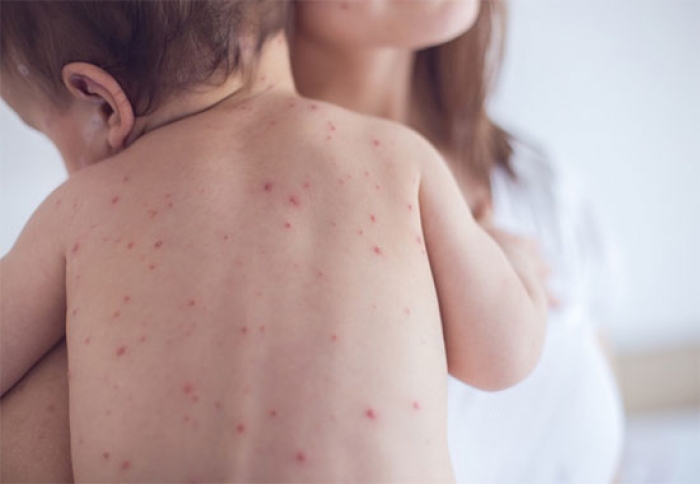 На Закарпатті офіційно зареєстровано 397 випадків захворювання на кір