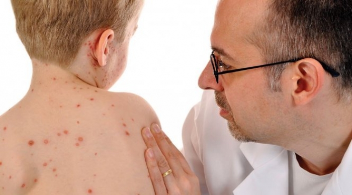 Кір в Ужгороді: наразі підтверджено 15 випадків захворювання у дітей дошкільного віку