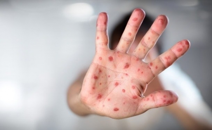 Кір на Закарпатті: майже 90 відсотків з усіх хворих – діти до 17 