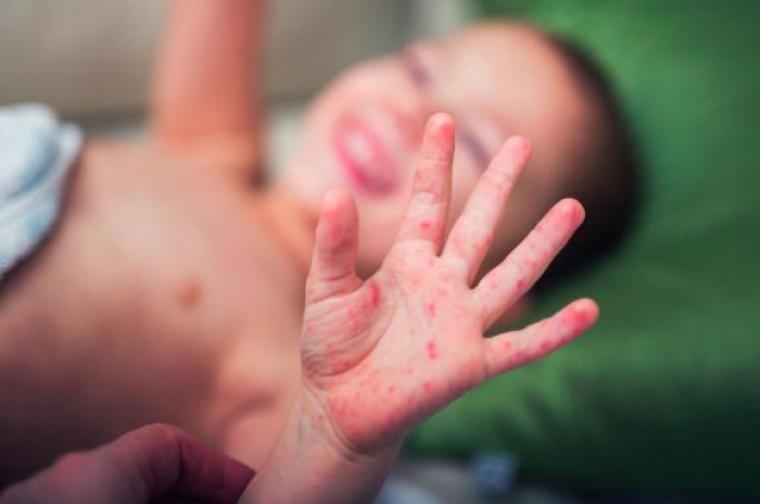 У Закарпатті – друга хвиля підйому захворюваності на кір