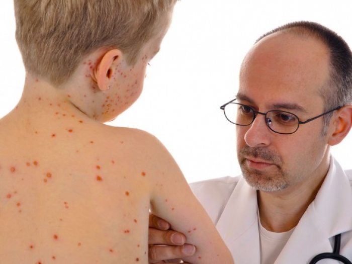 За останній тиждень в Закарпатті зареєстровано 142 випадки кору