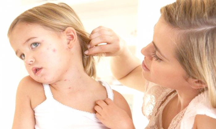 Стало відомо, яка ситуація із захворюванням на кір у Закарпатті