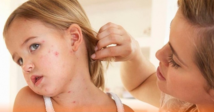 За попередній тиждень на Закарпатті зареєстровано 117 випадів кору