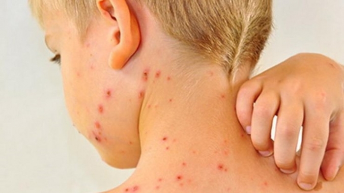 За 10 тижнів 2018 року кір вразив 1279 закарпатців