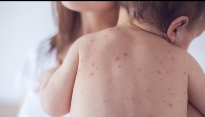 На Закарпатті зареєстровано 1646 випадків захворювання на кір з початку року