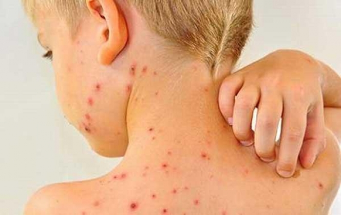 Кір на Закарпатті: за минулий тиждень зареєстровано 89 випадків захворювання