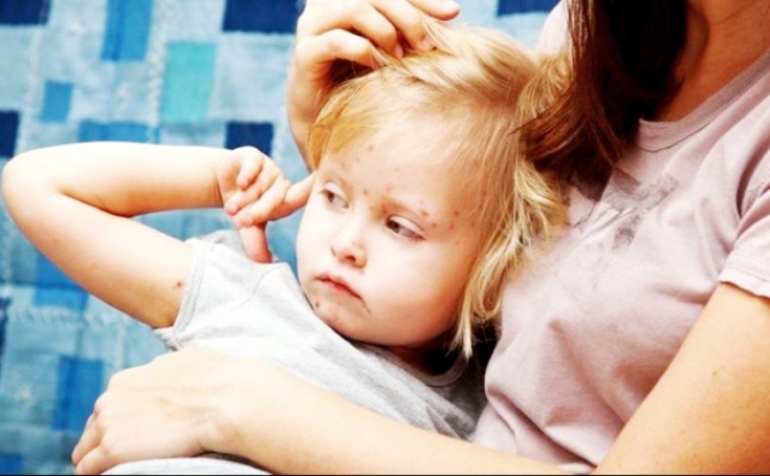 На сьогодні в Чорній Тисі вже захворіли на кір 118 чоловік