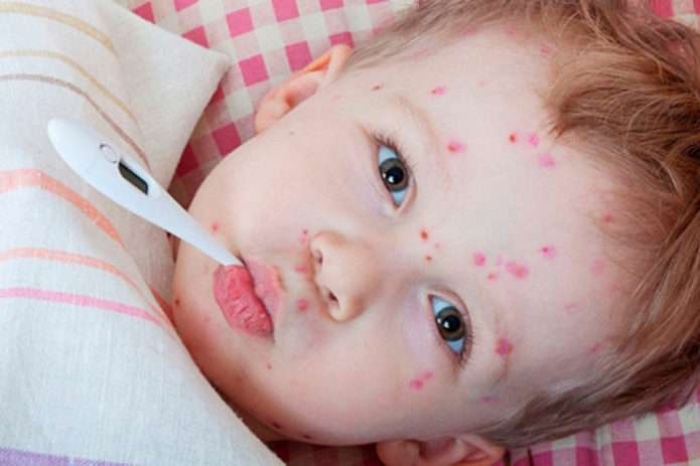 Епідемічна ситуація з кору на Закарпатті залишається напруженою