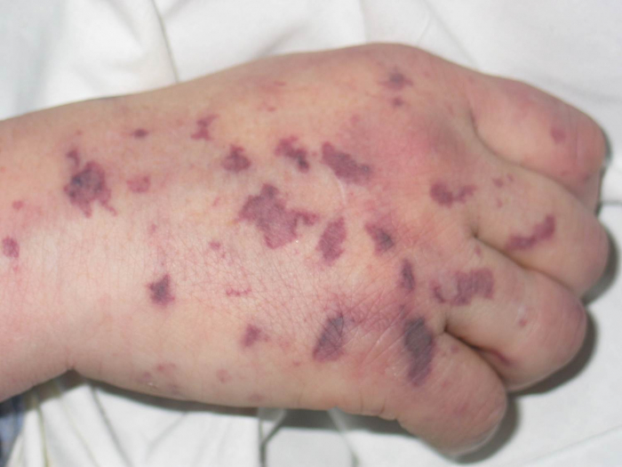 Сільську школу в глибинці Закарпаття закрили на карантин з діагнозом "менінгокок"