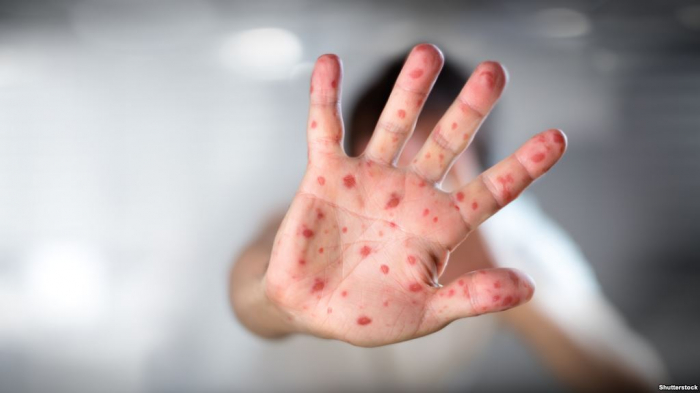 Рік тільки-но почався, а 420 закарпатців вже захворіли на кір