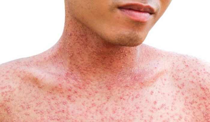 Ситуація з кором в Ужгороді: все частіше хворіють… дорослі!