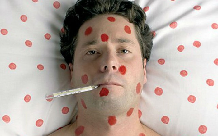 Минулого тижня в Закарпатті зареєстровано 56 випадків кору