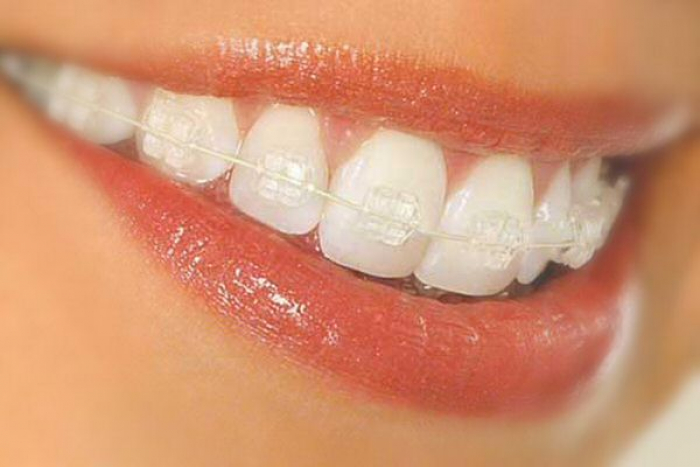 В каких ситуациях необходимы элайнеры для зубов?