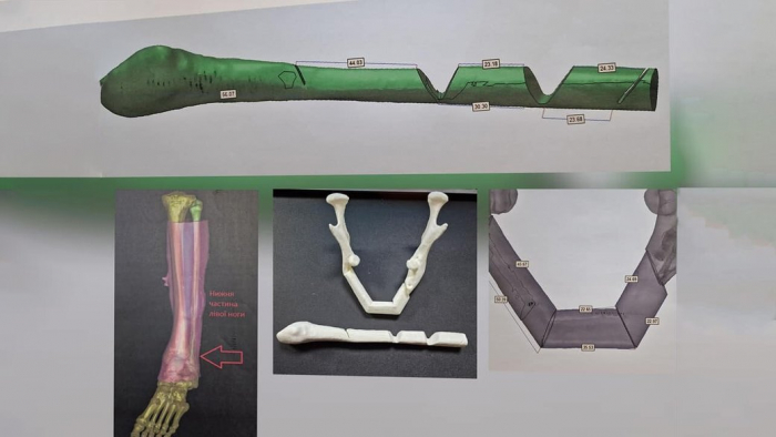 Вперше на Закарпатті провели реконструкцію обличчя, трансплантувавши частину малогомілкової кістки