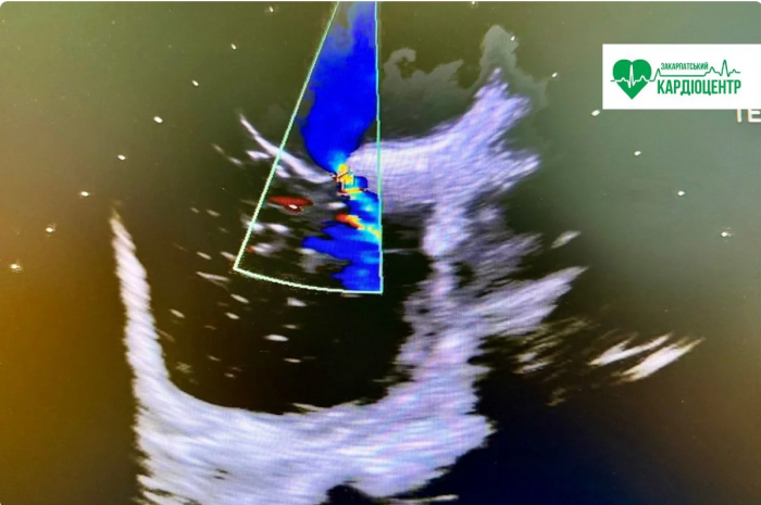 Маленькі бульбашки — велика діагностика: у Закарпатському кардіоцентрі виконують унікальне обстеження