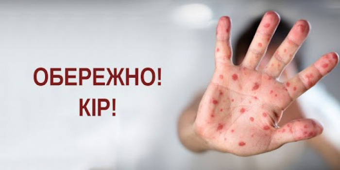 На Закарпатті фіксують випадки кору серед дітей: батьків закликають негайно перевірити вакцинальний статус